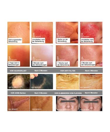 Koi Beauty 2mm Dermaroller - 200 Real Needles for Professional Microneedling Anti-Cellulite Massage & Scar Treatment at Home - Buy Online on GoSupps.com