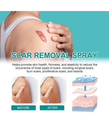 Scar Removal Spray- Advanced Formula for All Types of Scars - 2PCS - Buy Online on GoSupps.com