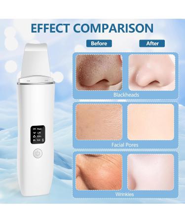 ACWOO Skin Scrubber - Effective Face Spatula Blackhead Remover & Pore Cleaner Tool for Deep Cleansing - Buy Online on GoSupps.com