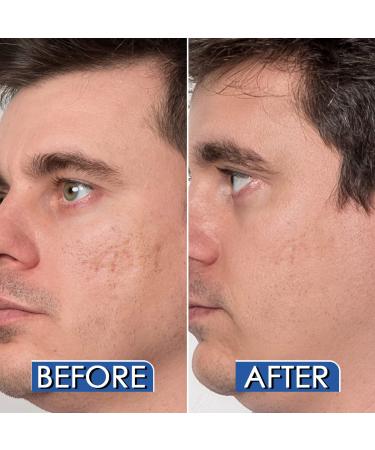 Particle Silicone Scar Gel - Advanced Remover (1.01 Oz) - Surgical, Acne, Burn, & Cut Scar Treatment - Enhances Appearance, Color & Texture - Buy Online on GoSupps.com