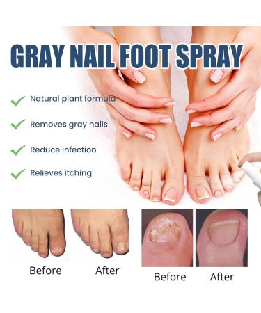 Furzero Medical Grade Nail Foot Spray - Foot Treatment Spray (1pc) - Buy Online on GoSupps.com