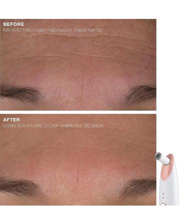 Trophy Skin MiniMD Handheld Microdermabrasion System - Enhances Texture and Skin Tone - Buy Online on GoSupps.com