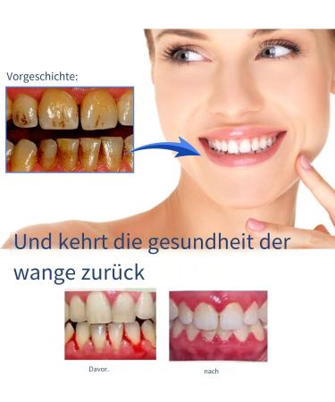 Lovilds Gingival Therapy Gel - Gum Instant Treatment & Periodontal Care (2PCS) for Fast Relief - Buy Online on GoSupps.com