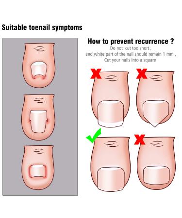 Ingrown Toenail Tools Kit - Toe Nail Correction Set with Lifter, Buckle, and Correction Patches - Buy Online on GoSupps.com