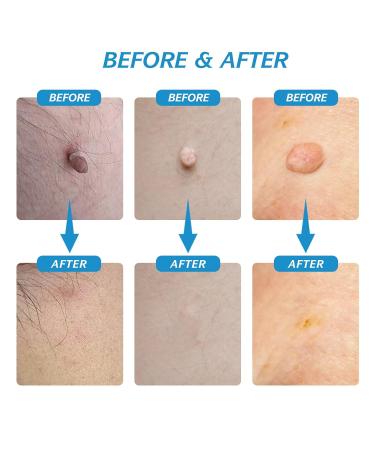 Skin Day Remover Kit | Quick & Painless Wart Removal | Safe for Micro to Large Warts (1mm-9mm) - Buy Online on GoSupps.com