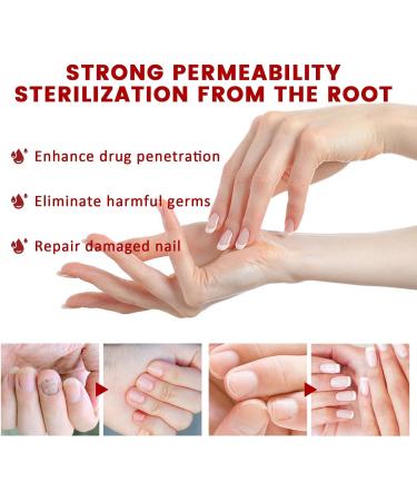 RZAJJN GFOUK Foot Corn Removal Extra Strength Gel 10ml - 2pcs - Buy Online on GoSupps.com
