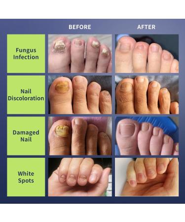 Effective Nail Fungus Light for Toenail & Fingernail Treatment | Restore Damaged & Discolored Nails - Buy Online on GoSupps.com