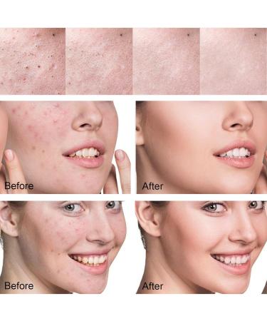 ARCHIDATE 30% Glycolic and 2% Salicylic Acid Pads Glycolic Acid Pad for Face Acne Blackhead Pore Deep Cleaning Oil Control Reduce Wrinkle Fine Line Exfoliation 50 Pads - Buy Online on GoSupps.com