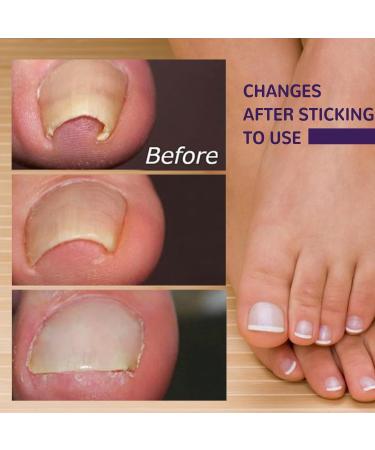 Grgowe Nail Correction Ingrown Toenail Corrector Foot Toenail Plasters Foot Correction Foot Toenail Correction for Care of Toenail Treatment Protect - Buy Online on GoSupps.com