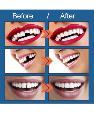 Horoper Temporary Tooth Repair Set | Formable Artificial Teeth for Quick Fix | Thermal Tooth Filling Beads & Tools for Missing or Broken Teeth - Buy Online on GoSupps.com