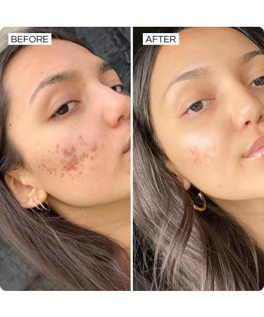 SONYA DAKAR Super Clear Serum - Acne Fighting with Salicylic Acid & Niacinamide | Minimize Pores Reduce Inflammation & Blemishes | International Shipping Available - Buy Online on GoSupps.com