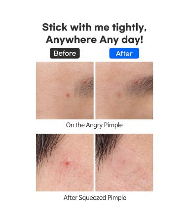 TIAM Surprise B Hydrocolloid Acne Pimple Patch - 96 Count (Pack of 4) | Fast Shipping Worldwide - Buy Online on GoSupps.com