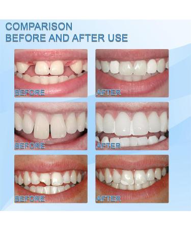 BAOK 5 PCs Provisional Denture Kit - DIY Dental Repair Set for Vampire Prostheses & Confident Smile - Buy Online on GoSupps.com