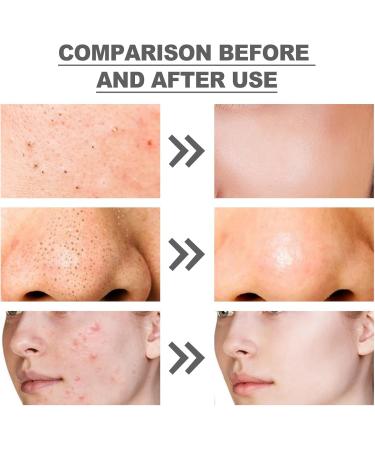 Azelaic Acid Suspension 10% Face Serum Azelaic Acid Serum Cream with Niacinamide & Vitamin C Anti Acne Cream Face Serum for Women Hydrating Serums Skincare to Reduces Blackheads Anti Aging Serum - Buy Online on GoSupps.com