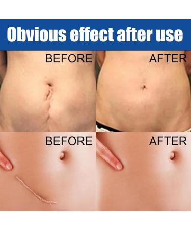 Best Scar Cream for All Types | Scar Angel - Effective Silicone Ointment for Stretch Marks & Post-Op Care - Buy Online on GoSupps.com