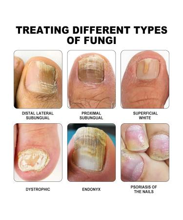 Furzero Pureail Nail Fungus Laser Therapy Device - Effective Fungus Treatment for Healthy Nails | Fast International Shipping - Buy Online on GoSupps.com