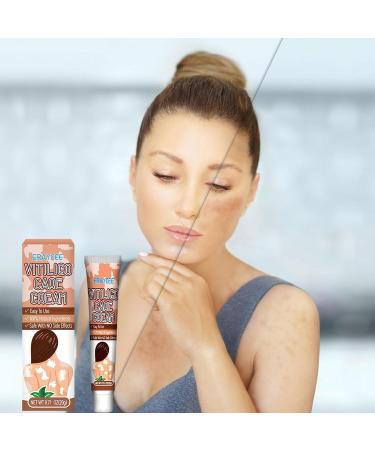  Hongjingda Skin lightening cream for vitiligo - 20g vitiligo relief cream for white patches on the skin reduces white patches improves epidermal melanocytes Hongjingda - Buy Online on GoSupps.com