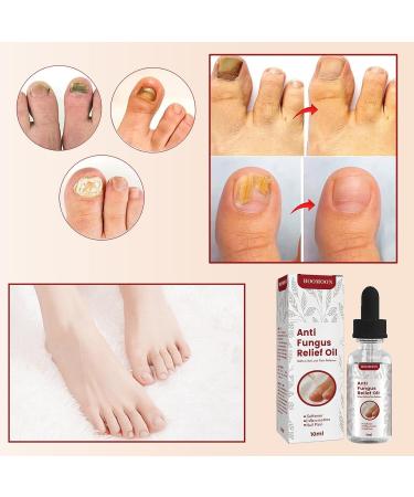 EUBEISAQI Toenail repair solution nail repair oil for damaged nails 10 ml nail softener care healthier extra strength nails renew damaged cracked ingrown toenail - Buy Online on GoSupps.com