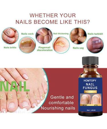 Durcisseur et fortifiant pour Ongles | Mycoses Solution Extra Forte pour Les Ongles - Patchs pour Ongles Anti-fongiques pour Le renouvellement des Ongles Force maximale pour Les - Buy Online on GoSupps.com