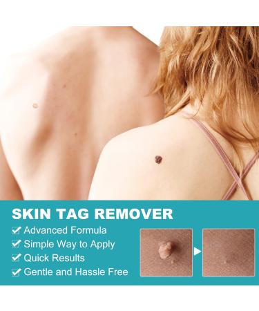 2-in-1 Skin Tag & Mole Remover Kit - Safe & Painless Removal for 2mm-8mm Sized Tags - Easy DIY at Home Green - Buy Online on GoSupps.com