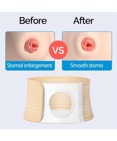 HEAXIY Ostomy Supplies - Elastic Hernia Support Belt for Men & Women | Prevent Stoma Hernia & Strengthen Colostomy | Large Size - Buy Online on GoSupps.com