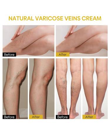 Furzero Bienengift Varicose Cream - Best Spider Vein & Pain Relief (2 Pieces) | Test Winner for Everyone - Buy Online on GoSupps.com