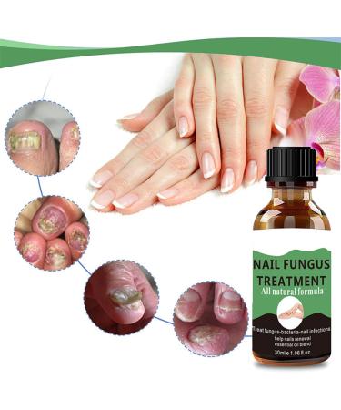 Fungal Nail Treatment - Extra Strong Nail Fungus Treatment for Toenail and Fingernail - Anti fungus Nail Repair and Strengthen Fix & Renew Damaged Broken Nails 1PC - Buy Online on GoSupps.com