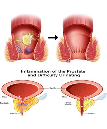 Adek Heca Natural Herbal Hemorrhoid Treatment Capsules & Suppository - Buy Online on GoSupps.com