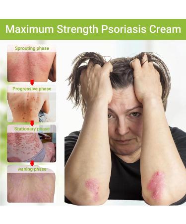 LMNOOP Psoriasis Cream - Maximum Strength Treatment for Psoriasis, Dermatitis, Rash - Fast Relief for Dry, Irritated Skin - 1.76 oz - Buy Online on GoSupps.com