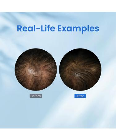 KX-826 DHT Blocker Hair Growth Spray | 1-Month Supply for Men & Women | Thicken Hair Reduce Hair Loss Visible Results in 4-6 Weeks | International Shipping Available - Buy Online on GoSupps.com