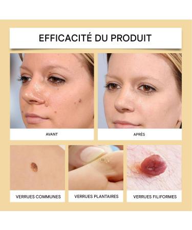 Mole Corrector Skin Blemish Correction Cream Reduces Imperfections 20g Moisturizer Safe for Face Hands Feet and Body - Buy Online on GoSupps.com