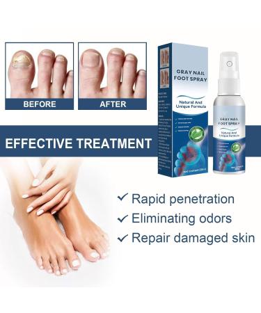 Furzero Medical Grade Nail Foot Spray - Foot Treatment Spray (1pc) - Buy Online on GoSupps.com