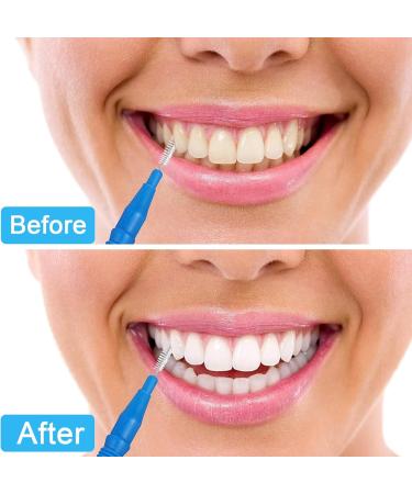 DHWEKU 6PC Aligner Removal Tool Set - Invisible Tooth Remover & Cleaner for Braces | Oral Care with 3 Cleaning Brushes - Buy Online on GoSupps.com