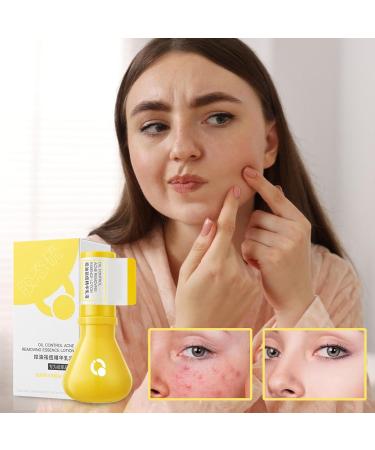 Bump Remover Face Lotion 30ml Natural Face Skin Soothing Bump Lotion Women Girls Day And Night Use Gentle Skin Care Lotion For Sister Mom - Buy Online on GoSupps.com