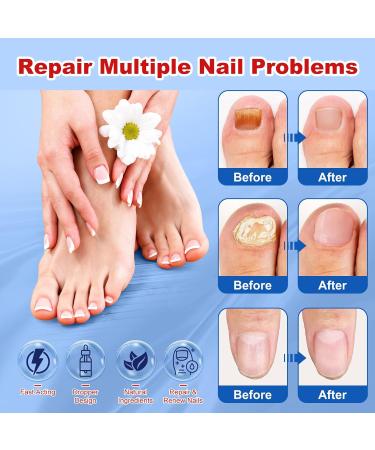 Buy Extra Strength Toenail Fungus Treatment - Fast Acting Nail Fungus Remover for Men & Women - 30mL Liquid Solution - Buy Online on GoSupps.com