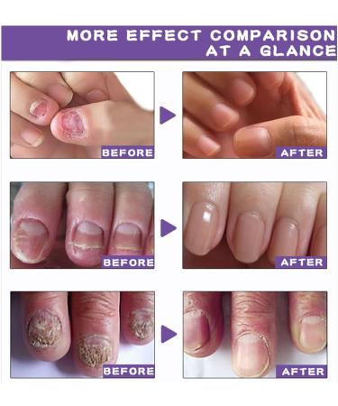 Nail Fungal Treatment Spray - Advanced Toenail & Nail Strengthener Repair - 10ml - Buy Online on GoSupps.com