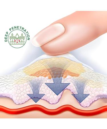 Cr me Pour L' limination Des Lipomes | 30g limination Douce Des Lipomes Pommade Apaisante pour la Peau - Pour Visage Corps Articulations Jambe Bras Dos Routine Quotidienne Nuit Voyage Massage - Buy Online on GoSupps.com