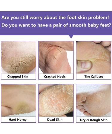 NewFoot Foot Peel Mask 2 Pack - Exfoliating Natural Masks for Dry Cracked Feet - Moisturizing and Softening Callus Treatment - Smooth Baby Feet - Purple - Buy Online on GoSupps.com