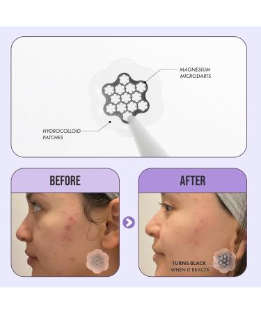 Deep Blemish Microdarts | Fast-Acting Pimple Patch for Cystic Acne | Hydrocolloid Spot Care with Magnesium & Tea Tree | International Shipping Available - Buy Online on GoSupps.com