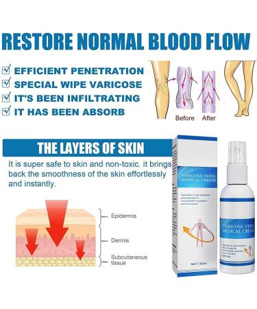 Vein Fix Varicose Treatment Spray - Spider Vein & Varicose Veins Miracle Relief - Buy Online on GoSupps.com