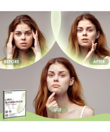 AUSLKA Blemishes Patches - 44 Hydrocolloid Spot Dots for Large Area Breakouts - Buy Online on GoSupps.com