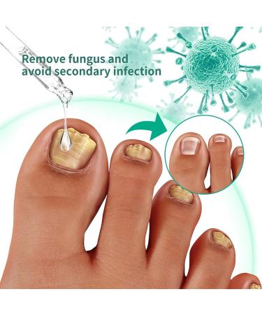 Nail Repair Essence for Fingernail & Toenail Fungus - Repairs, Protects, and Strengthens Nails (3 Pcs) - Buy Online on GoSupps.com