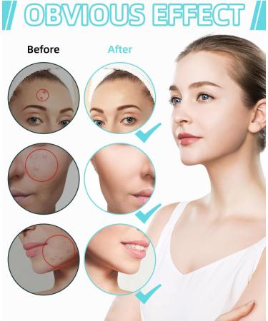 360 Pcs Hydrocolloid Pimple Patches - Invisible & Natural with Tea Tree Oil for Quick Healing of Acne & Breakouts - Buy Online on GoSupps.com