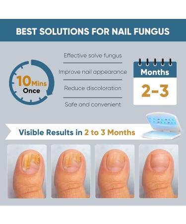 Nail Fungus Light Device for Onychomycosis - Safe & Effective Home Use for Toenail & Fingernail Solutions - Buy Online on GoSupps.com
