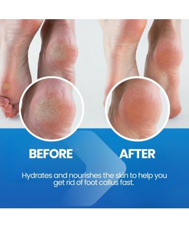 Callus Remover for Feet Extra Strength with Stainless Steel Foot File (Pedicure Grade) - Professional Foot Rasp Callus Remover Softener - Callus Treatment Heels and Hands - Cuticle Remover & Softener - Buy Online on GoSupps.com