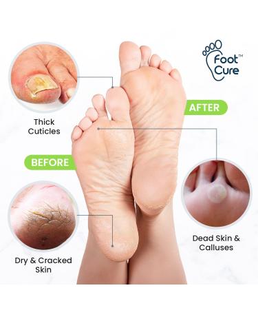 Tea Tree Foot Soak & Callus Remover Gel Kit - Antifungal Soak with Epsom Salts for Calluses, Dry Cracked Heels, Toenail Fungus, and Odor - Tea Tree Oil Pedicure for Tired Feet - Buy Online on GoSupps.com