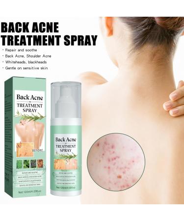 Herbaluxy Back Acne Treatment Spray - Clear Body Acne & Lighten Marks Deep Cleans & Gentle on Skin - Buy Online on GoSupps.com