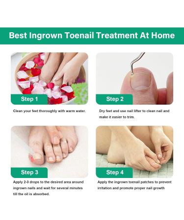 Ingrown Toenail Treatment Kit - Softener Drops Lifter Nail Patches & Tools for Easy Home Care - Buy Online on GoSupps.com