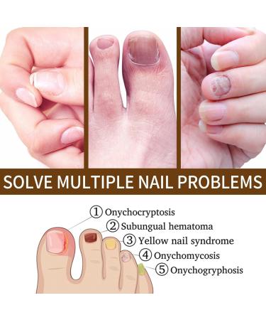 TBeautfave Fungal Nail Treatment Nail Fungus Treatment for Toenail Fungal Nail Treatment for Toenails Extra Strong Nail Strengthener for Damaged Nails Nail Repair Renew Broken Nails Nail Care - Buy Online on GoSupps.com