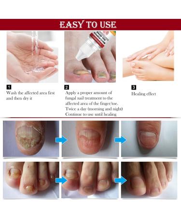 Fungal Nail Treatment for Toenail Extra Strong Multi-purpose Nail Repair Lotion for Fingernails Toenails Toe Nail Fungal Treatment Fixes Discolored Nails Safe Effective(10ML Red) - Buy Online on GoSupps.com